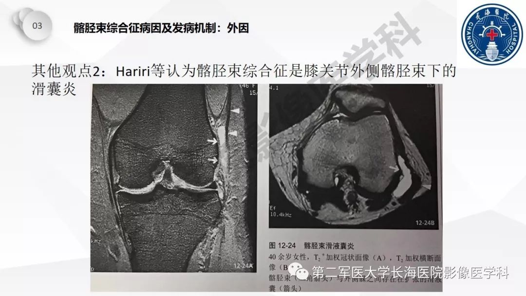影像PPT - 【PPT】髂胫束摩擦综合症/髂胫束综合症-23