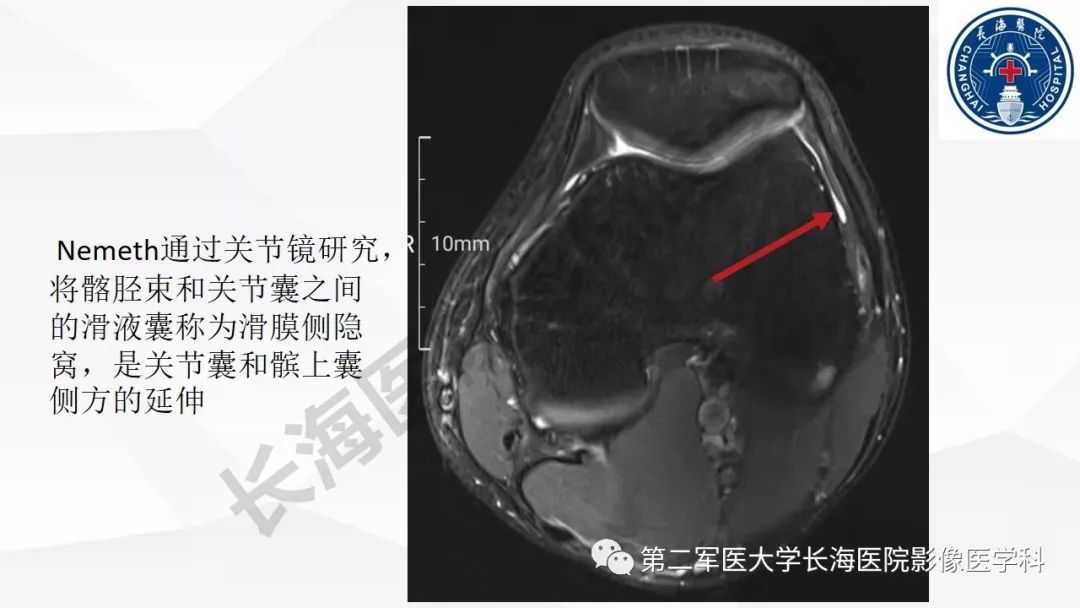 影像PPT - 【PPT】髂胫束摩擦综合症/髂胫束综合症-24