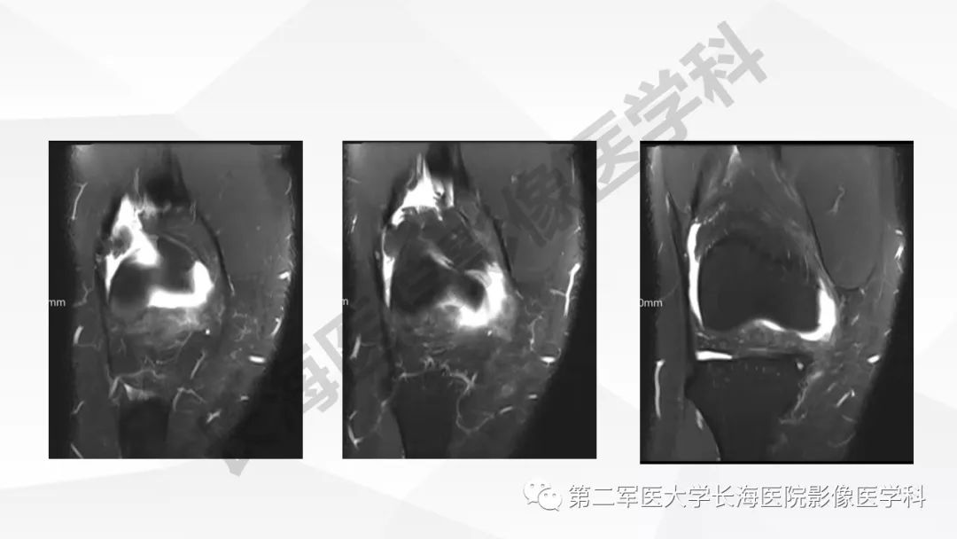 影像PPT - 【PPT】髂胫束摩擦综合症/髂胫束综合症-25