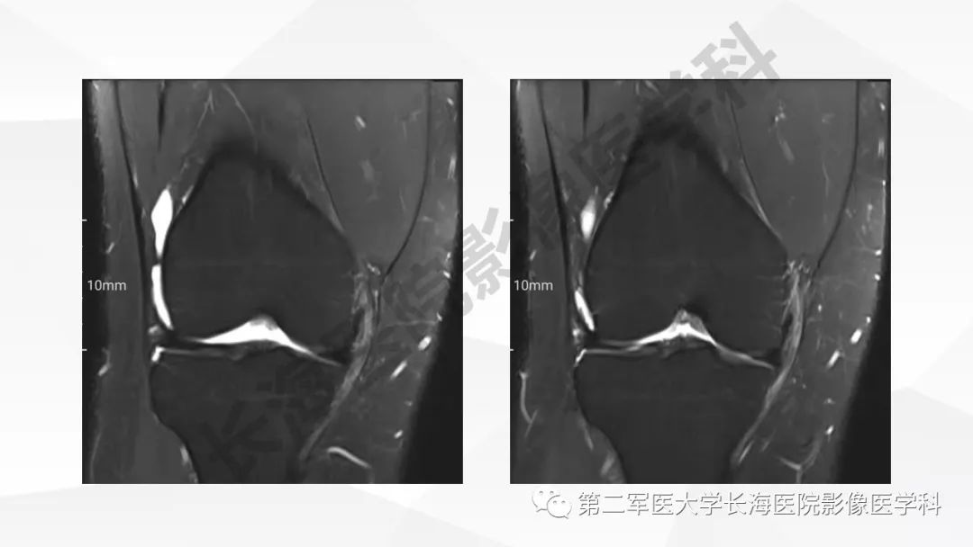 影像PPT - 【PPT】髂胫束摩擦综合症/髂胫束综合症-26