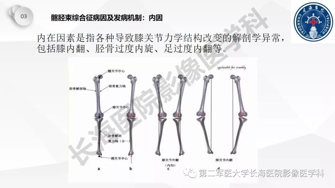 影像PPT - 【PPT】髂胫束摩擦综合症/髂胫束综合症-27