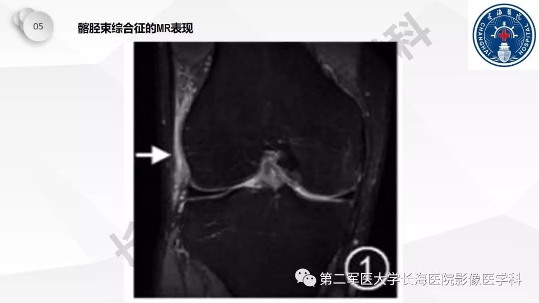 影像PPT - 【PPT】髂胫束摩擦综合症/髂胫束综合症-35