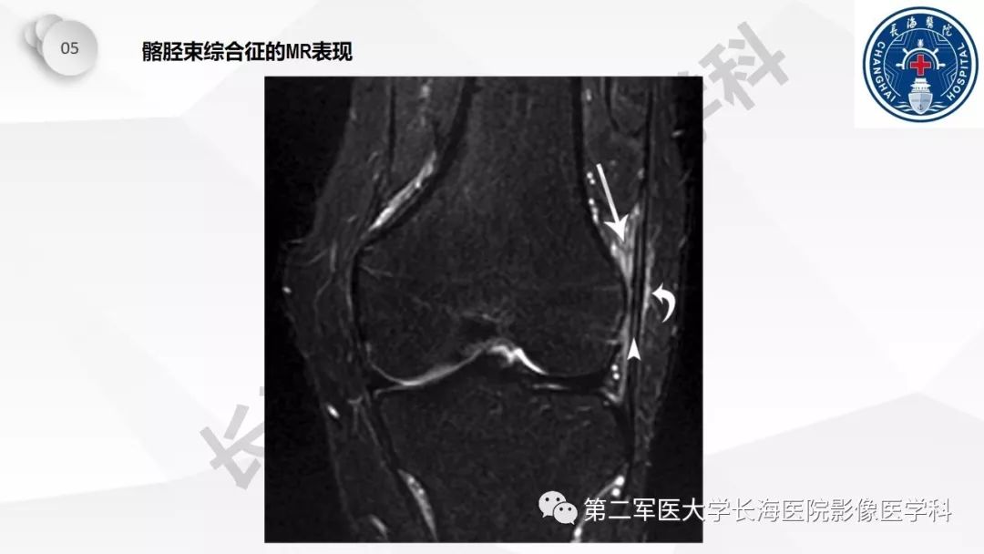 影像PPT - 【PPT】髂胫束摩擦综合症/髂胫束综合症-36