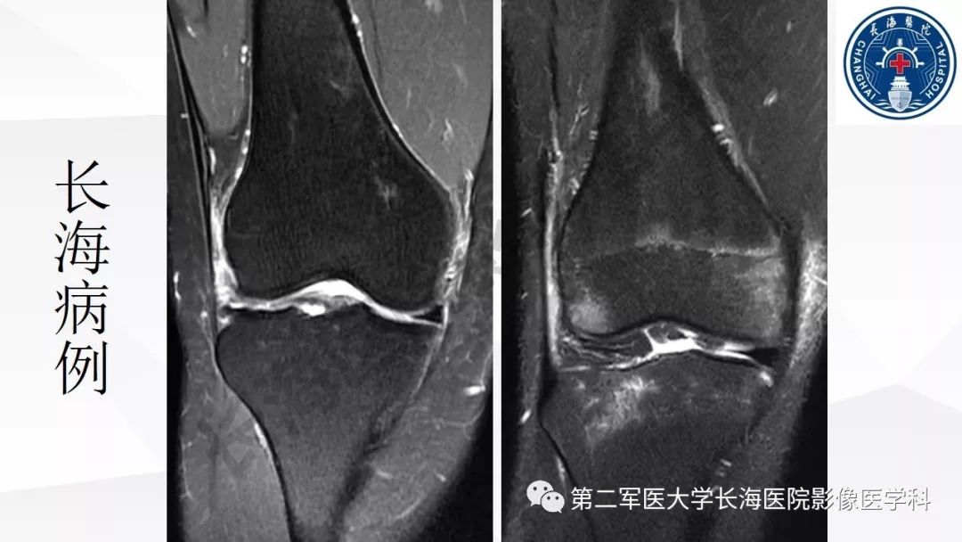 影像PPT - 【PPT】髂胫束摩擦综合症/髂胫束综合症-39