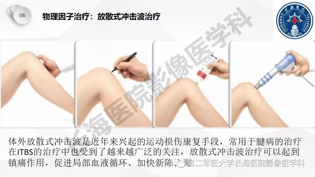 影像PPT - 【PPT】髂胫束摩擦综合症/髂胫束综合症-45