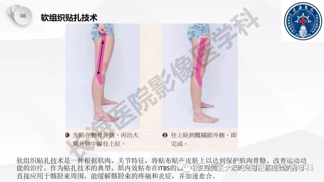 影像PPT - 【PPT】髂胫束摩擦综合症/髂胫束综合症-46