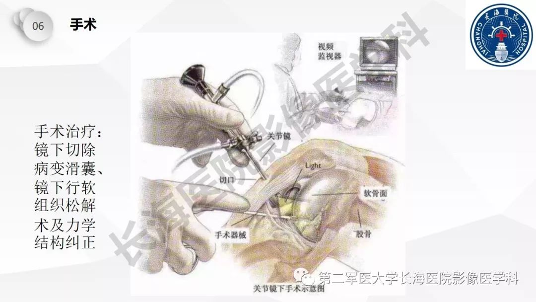 影像PPT - 【PPT】髂胫束摩擦综合症/髂胫束综合症-49