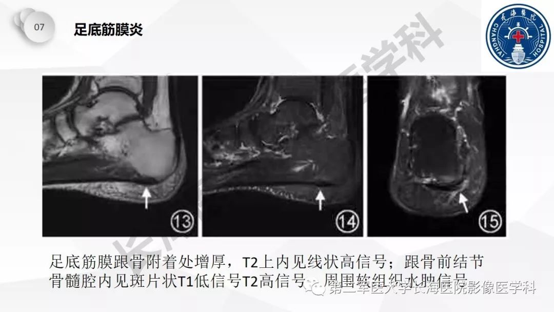 影像PPT - 【PPT】髂胫束摩擦综合症/髂胫束综合症-51