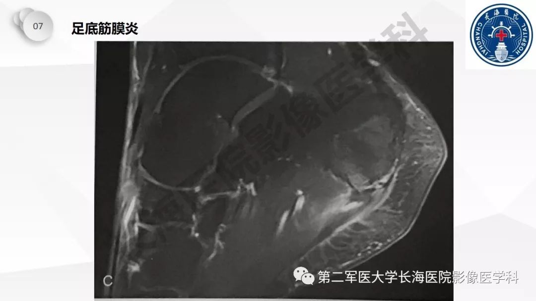 影像PPT - 【PPT】髂胫束摩擦综合症/髂胫束综合症-52