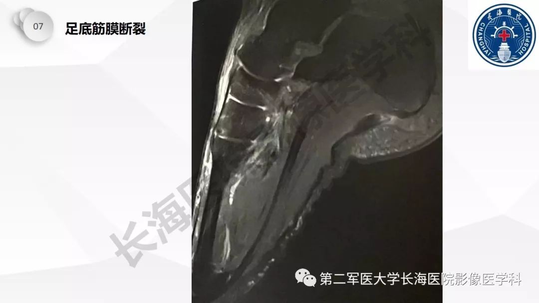 影像PPT - 【PPT】髂胫束摩擦综合症/髂胫束综合症-53
