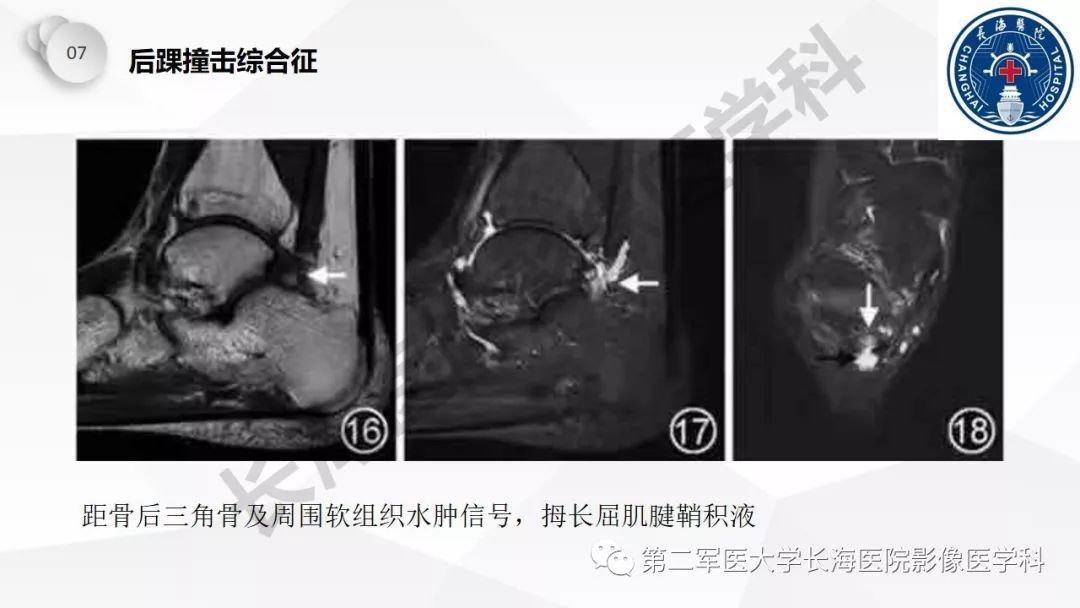 影像PPT - 【PPT】髂胫束摩擦综合症/髂胫束综合症-54