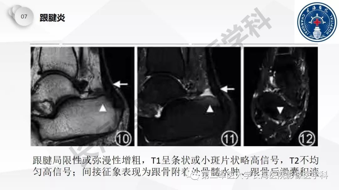 影像PPT - 【PPT】髂胫束摩擦综合症/髂胫束综合症-55