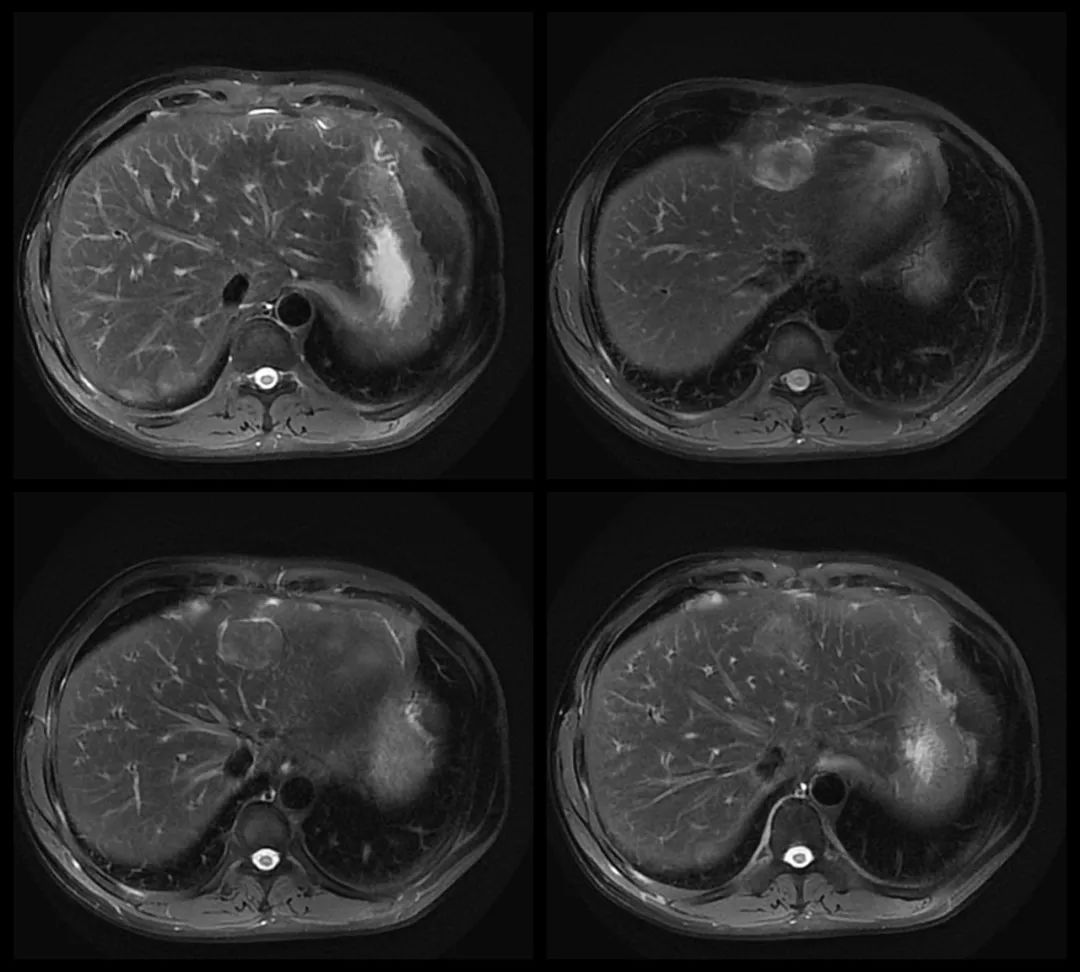 影像PPT - 【病例】腹腔异位脾种植1例CT及MR影像-4 影像PPT - 【病例】腹腔异位脾种植1例CT及MR影像-4