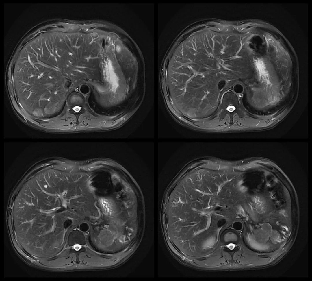 影像PPT - 【病例】腹腔异位脾种植1例CT及MR影像-5 影像PPT - 【病例】腹腔异位脾种植1例CT及MR影像-5
