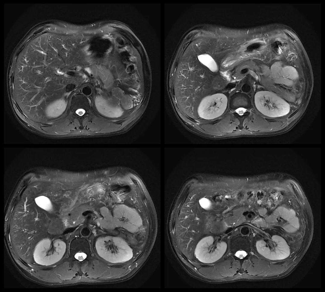 影像PPT - 【病例】腹腔异位脾种植1例CT及MR影像-6 影像PPT - 【病例】腹腔异位脾种植1例CT及MR影像-6