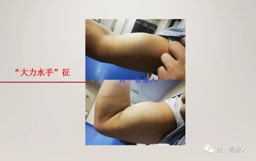 影像PPT - 【PPT】上臂大力水手征—肱二头肌长头腱断裂-6