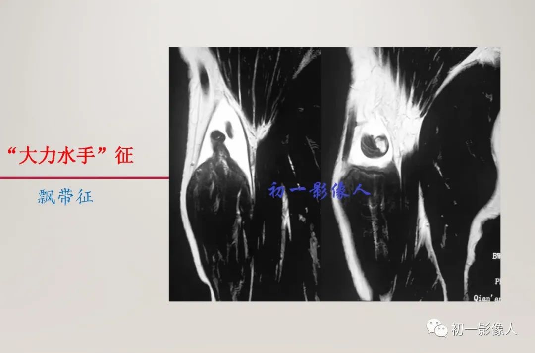 影像PPT - 【PPT】上臂大力水手征—肱二头肌长头腱断裂-7