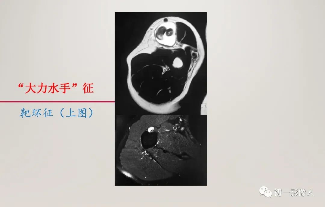 影像PPT - 【PPT】上臂大力水手征—肱二头肌长头腱断裂-9