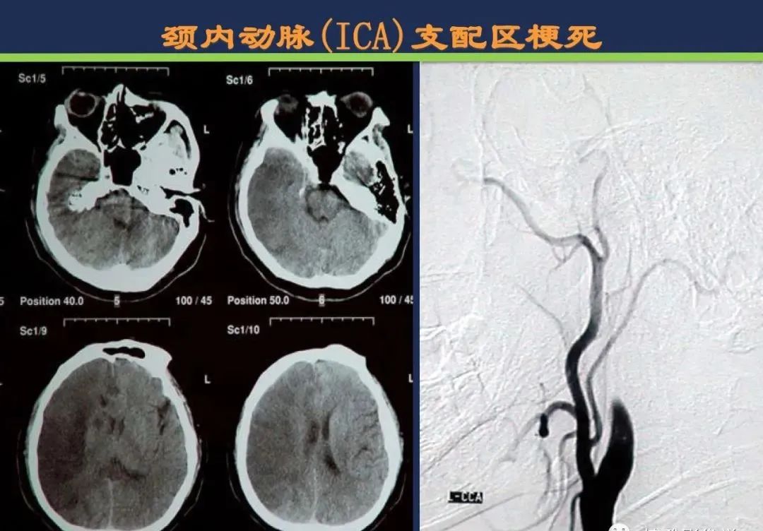 影像PPT - 从梗死部位推测责任血管:脑血管解剖-14 影像PPT - 从梗死部位推测责任血管:脑血管解剖-14