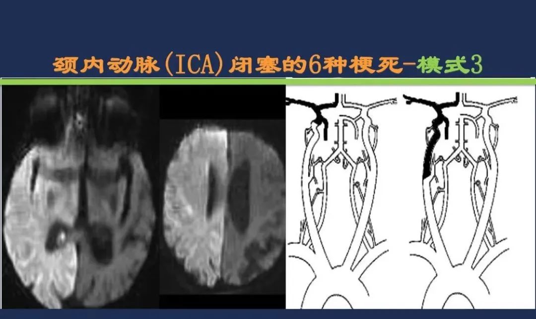 影像PPT - 从梗死部位推测责任血管:脑血管解剖-17 影像PPT - 从梗死部位推测责任血管:脑血管解剖-17