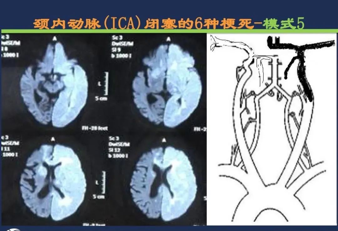 影像PPT - 从梗死部位推测责任血管:脑血管解剖-19 影像PPT - 从梗死部位推测责任血管:脑血管解剖-19
