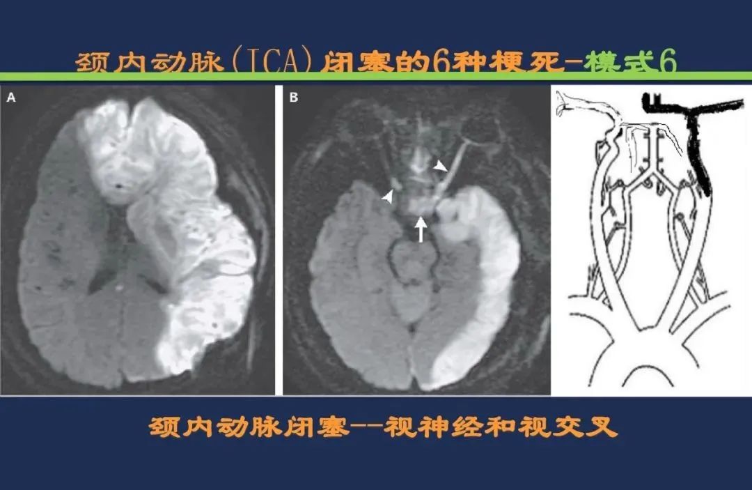 影像PPT - 从梗死部位推测责任血管:脑血管解剖-20 影像PPT - 从梗死部位推测责任血管:脑血管解剖-20