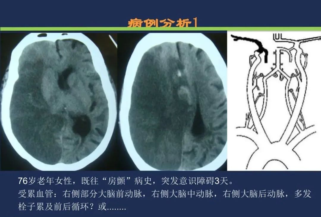 影像PPT - 从梗死部位推测责任血管:脑血管解剖-21 影像PPT - 从梗死部位推测责任血管:脑血管解剖-21