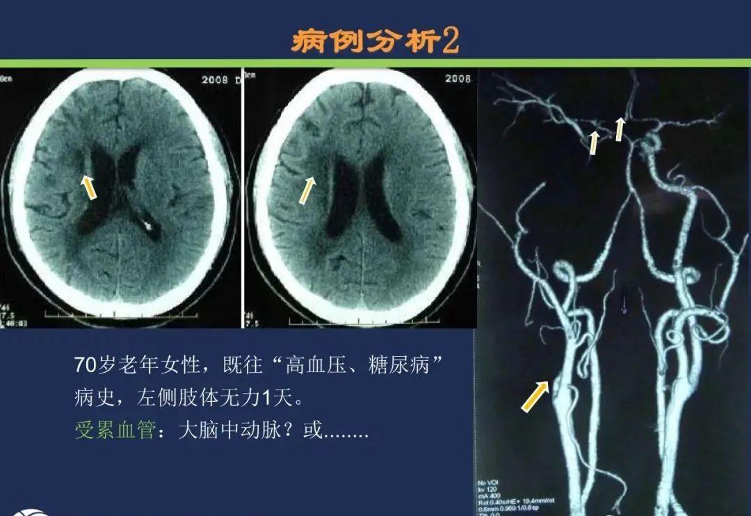 影像PPT - 从梗死部位推测责任血管:脑血管解剖-22 影像PPT - 从梗死部位推测责任血管:脑血管解剖-22