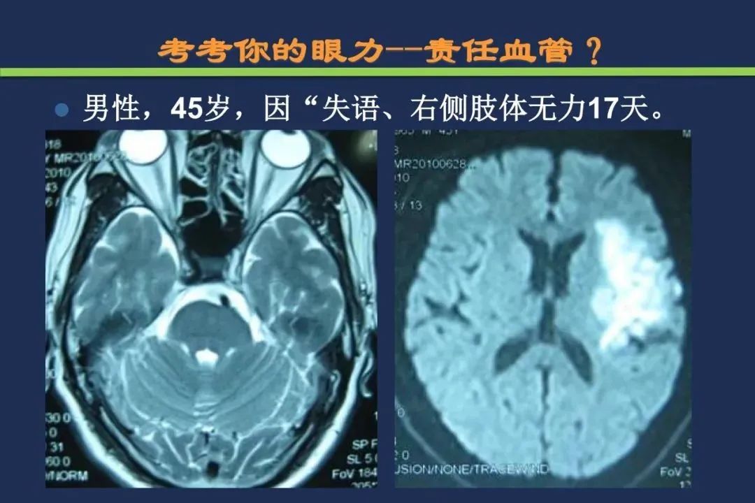 影像PPT - 从梗死部位推测责任血管:脑血管解剖-26 影像PPT - 从梗死部位推测责任血管:脑血管解剖-26