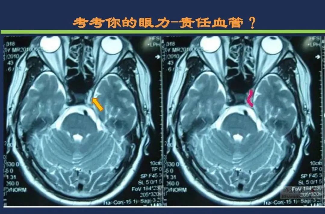 影像PPT - 从梗死部位推测责任血管:脑血管解剖-27 影像PPT - 从梗死部位推测责任血管:脑血管解剖-27