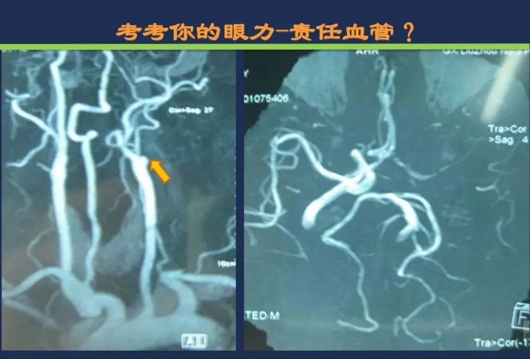 影像PPT - 从梗死部位推测责任血管:脑血管解剖-28 影像PPT - 从梗死部位推测责任血管:脑血管解剖-28
