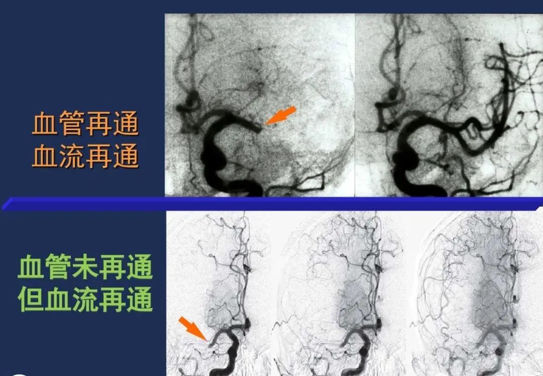 影像PPT - 从梗死部位推测责任血管:脑血管解剖-29 影像PPT - 从梗死部位推测责任血管:脑血管解剖-29