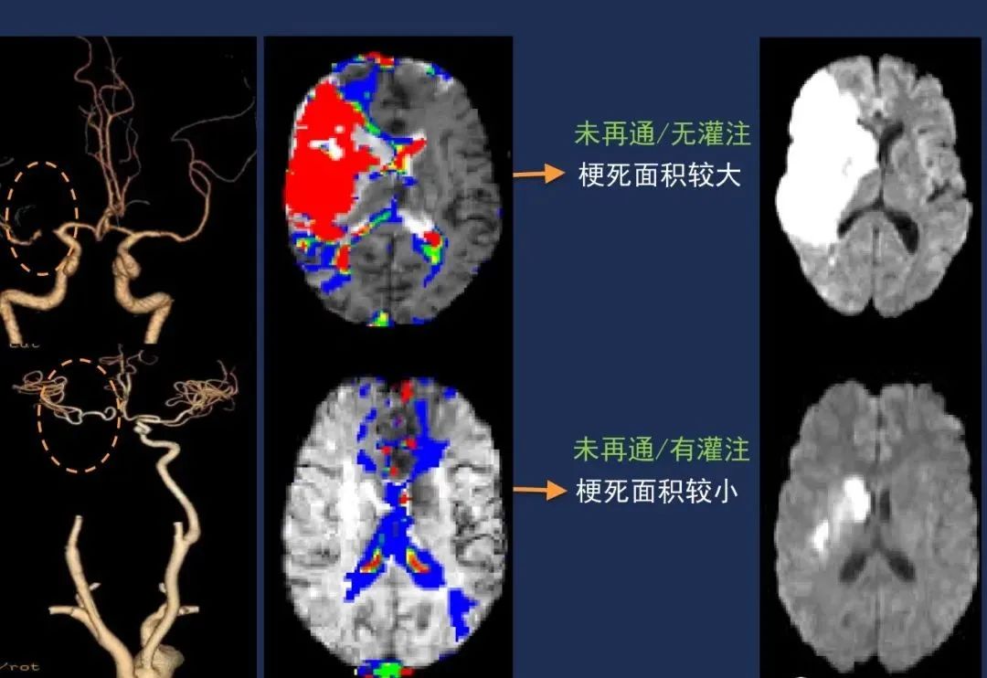 影像PPT - 从梗死部位推测责任血管:脑血管解剖-30 影像PPT - 从梗死部位推测责任血管:脑血管解剖-30