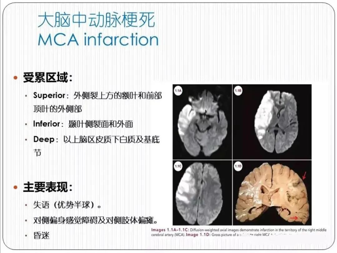 影像PPT - 从梗死部位推测责任血管:脑血管解剖-35 影像PPT - 从梗死部位推测责任血管:脑血管解剖-35