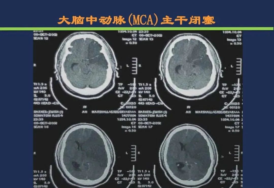 影像PPT - 从梗死部位推测责任血管:脑血管解剖-38 影像PPT - 从梗死部位推测责任血管:脑血管解剖-38