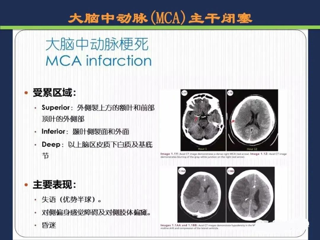 影像PPT - 从梗死部位推测责任血管:脑血管解剖-39 影像PPT - 从梗死部位推测责任血管:脑血管解剖-39