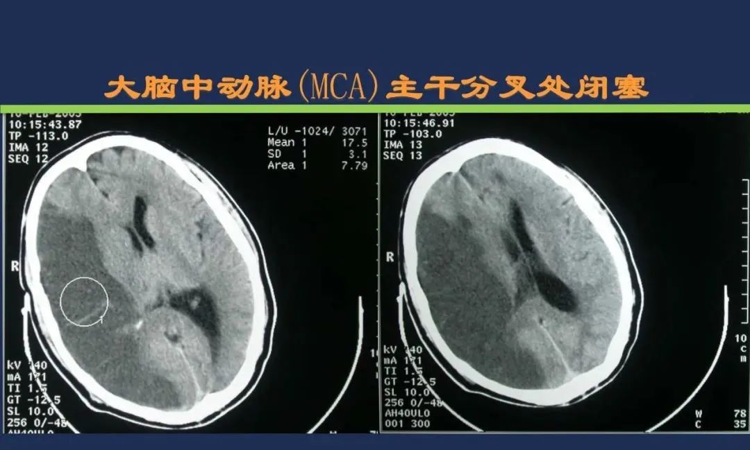 影像PPT - 从梗死部位推测责任血管:脑血管解剖-40 影像PPT - 从梗死部位推测责任血管:脑血管解剖-40
