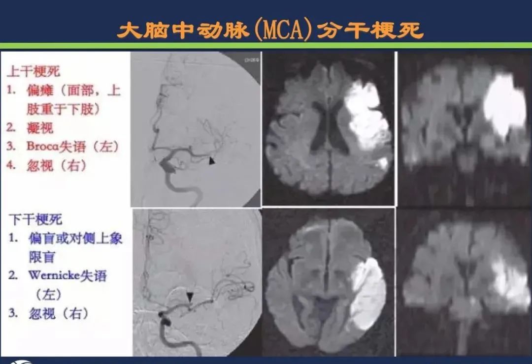 影像PPT - 从梗死部位推测责任血管:脑血管解剖-41 影像PPT - 从梗死部位推测责任血管:脑血管解剖-41