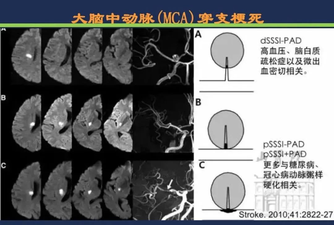 影像PPT - 从梗死部位推测责任血管:脑血管解剖-42 影像PPT - 从梗死部位推测责任血管:脑血管解剖-42