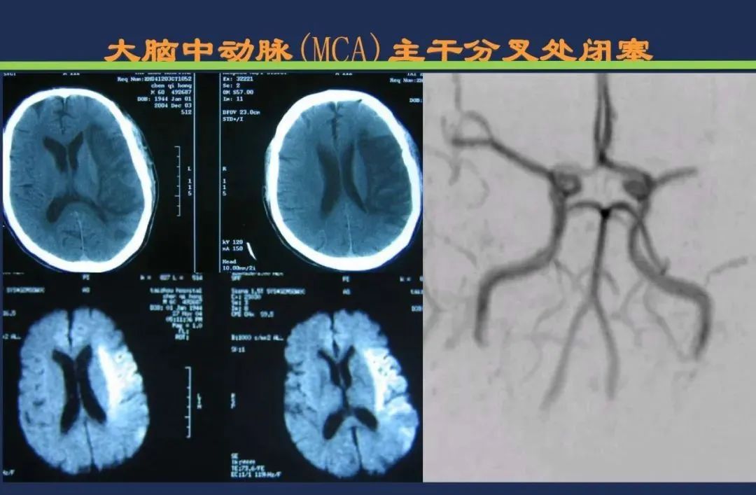 影像PPT - 从梗死部位推测责任血管:脑血管解剖-43 影像PPT - 从梗死部位推测责任血管:脑血管解剖-43