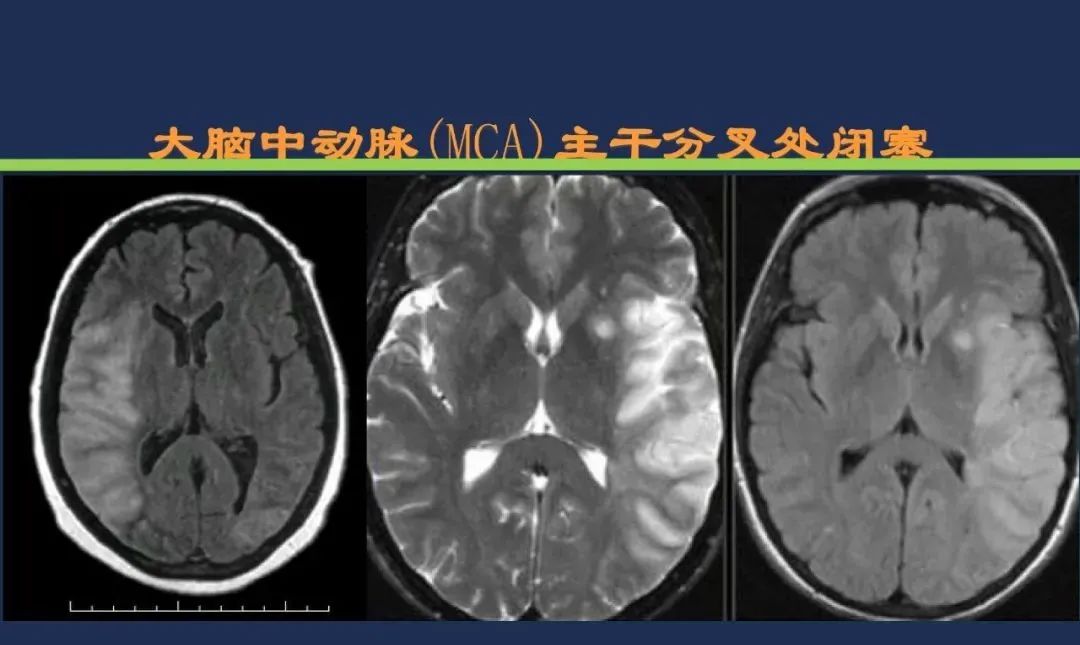 影像PPT - 从梗死部位推测责任血管:脑血管解剖-44 影像PPT - 从梗死部位推测责任血管:脑血管解剖-44