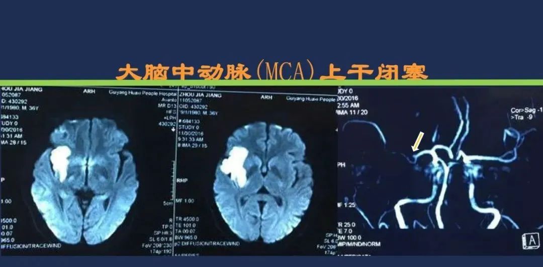 影像PPT - 从梗死部位推测责任血管:脑血管解剖-45 影像PPT - 从梗死部位推测责任血管:脑血管解剖-45