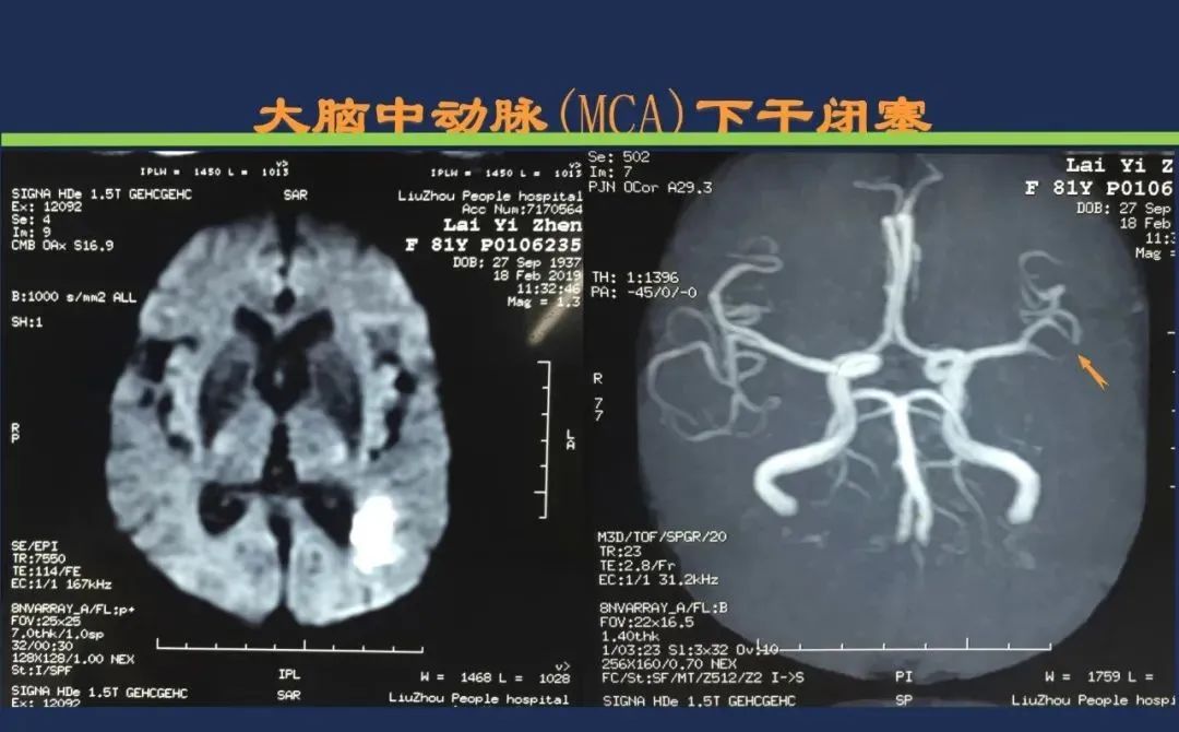 影像PPT - 从梗死部位推测责任血管:脑血管解剖-46 影像PPT - 从梗死部位推测责任血管:脑血管解剖-46