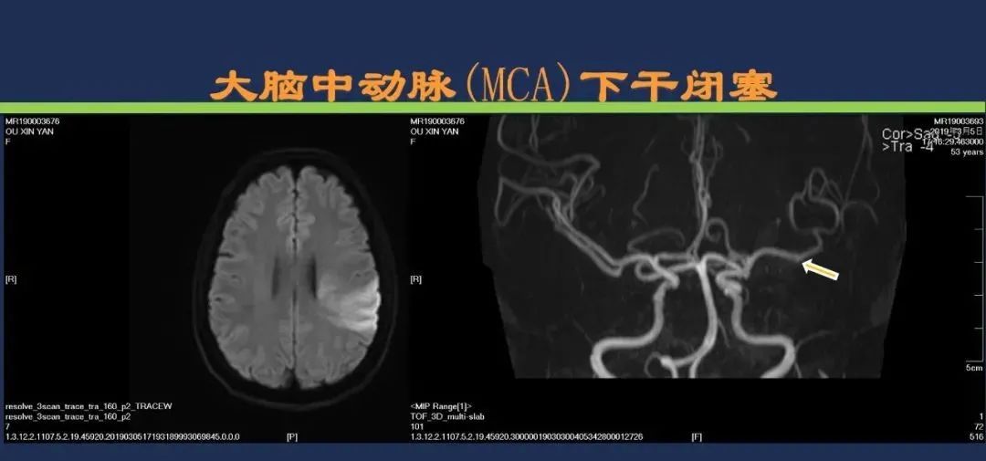影像PPT - 从梗死部位推测责任血管:脑血管解剖-47 影像PPT - 从梗死部位推测责任血管:脑血管解剖-47