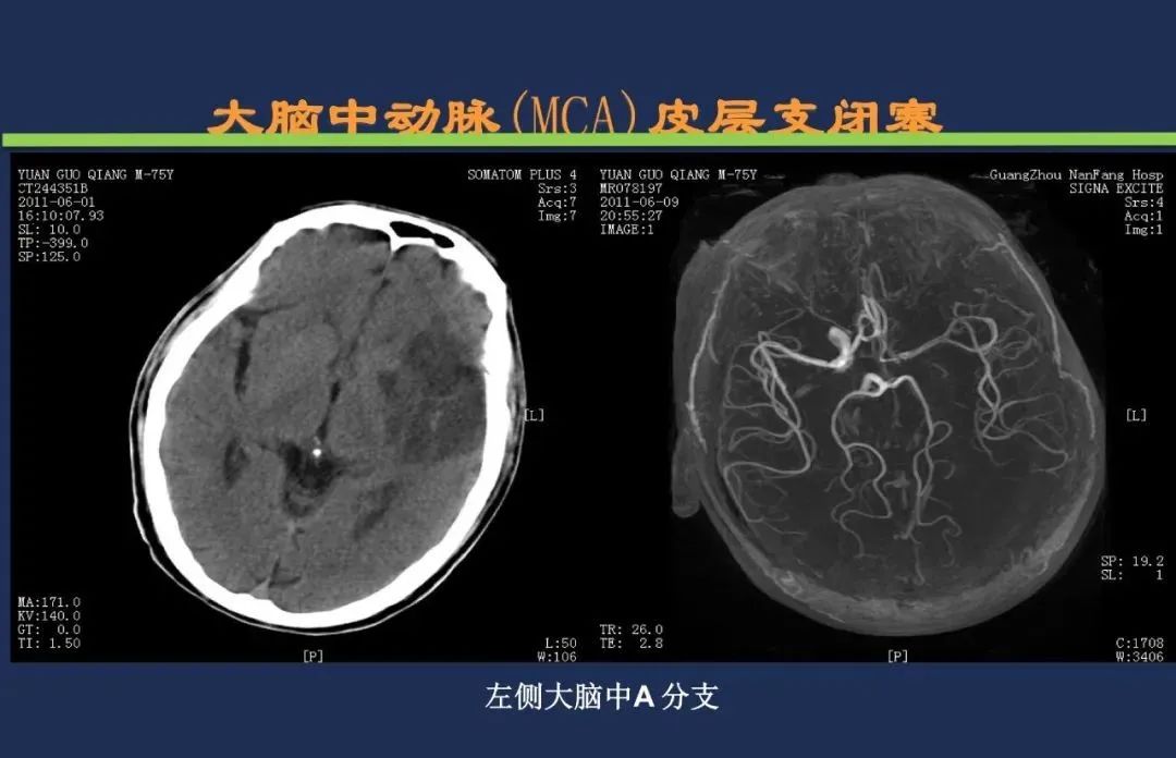 影像PPT - 从梗死部位推测责任血管:脑血管解剖-48 影像PPT - 从梗死部位推测责任血管:脑血管解剖-48