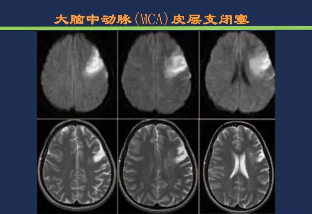 影像PPT - 从梗死部位推测责任血管:脑血管解剖-49 影像PPT - 从梗死部位推测责任血管:脑血管解剖-49