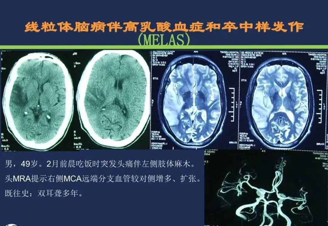 影像PPT - 从梗死部位推测责任血管:脑血管解剖-50 影像PPT - 从梗死部位推测责任血管:脑血管解剖-50