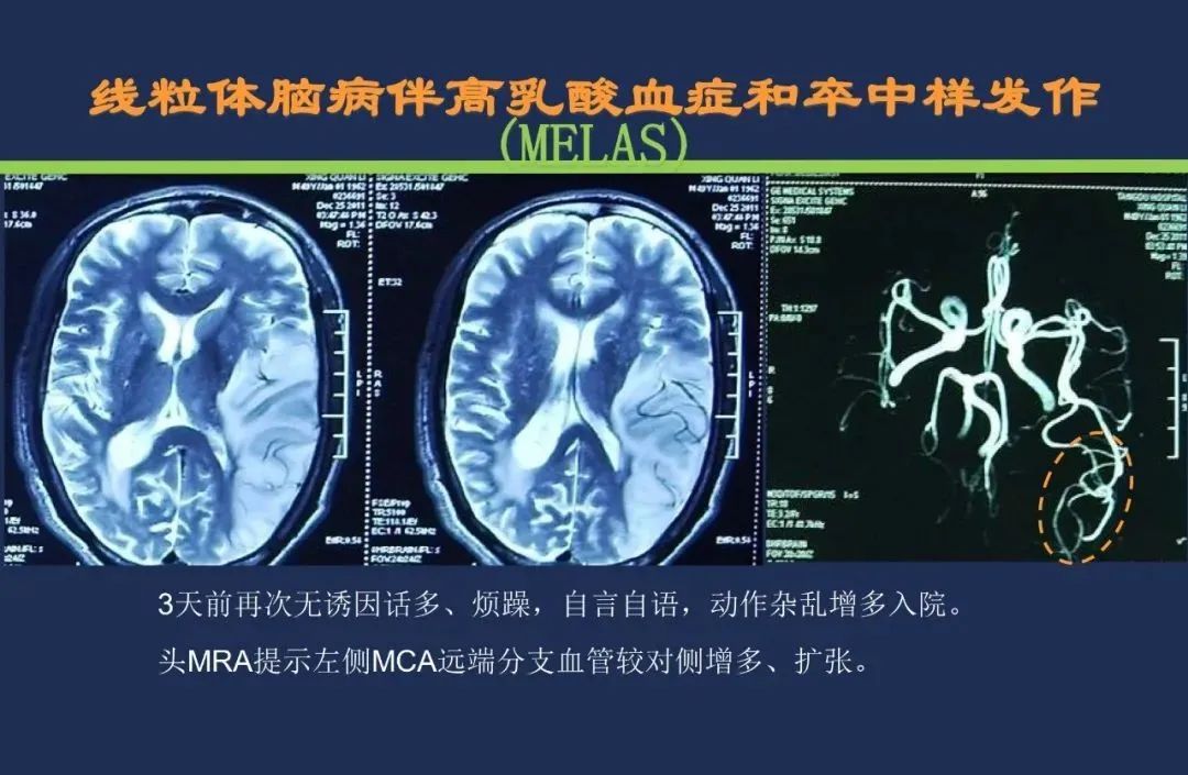 影像PPT - 从梗死部位推测责任血管:脑血管解剖-51 影像PPT - 从梗死部位推测责任血管:脑血管解剖-51