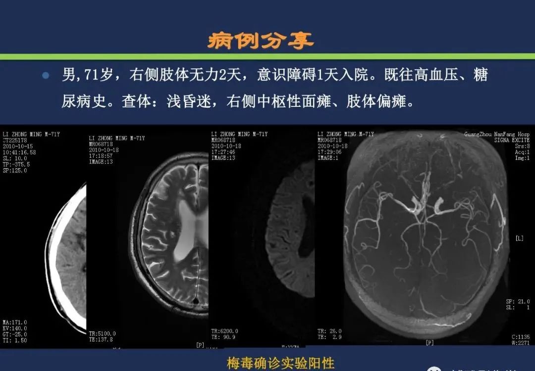影像PPT - 从梗死部位推测责任血管:脑血管解剖-52 影像PPT - 从梗死部位推测责任血管:脑血管解剖-52