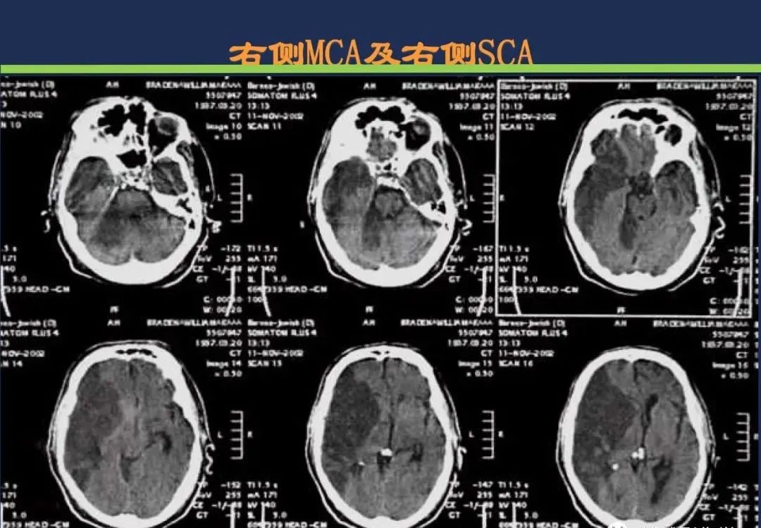 影像PPT - 从梗死部位推测责任血管:脑血管解剖-53 影像PPT - 从梗死部位推测责任血管:脑血管解剖-53